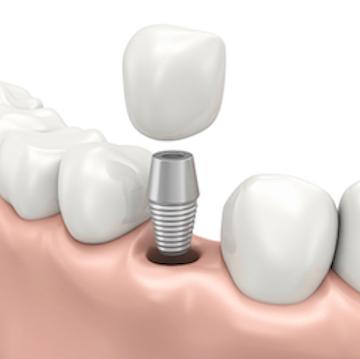 Diagram of dental implant replacing missing tooth at dentist in Edmond, OK