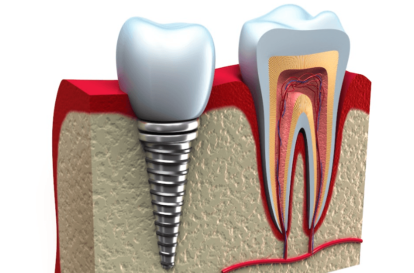 An illustration of a dental implant in Edmond dental Center