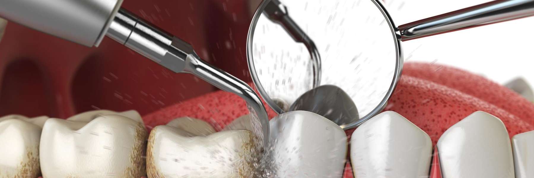 An illustration of dental cleaning in Edmond, OK