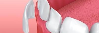 An illustration of veneer covering tooth in Edmond OK
