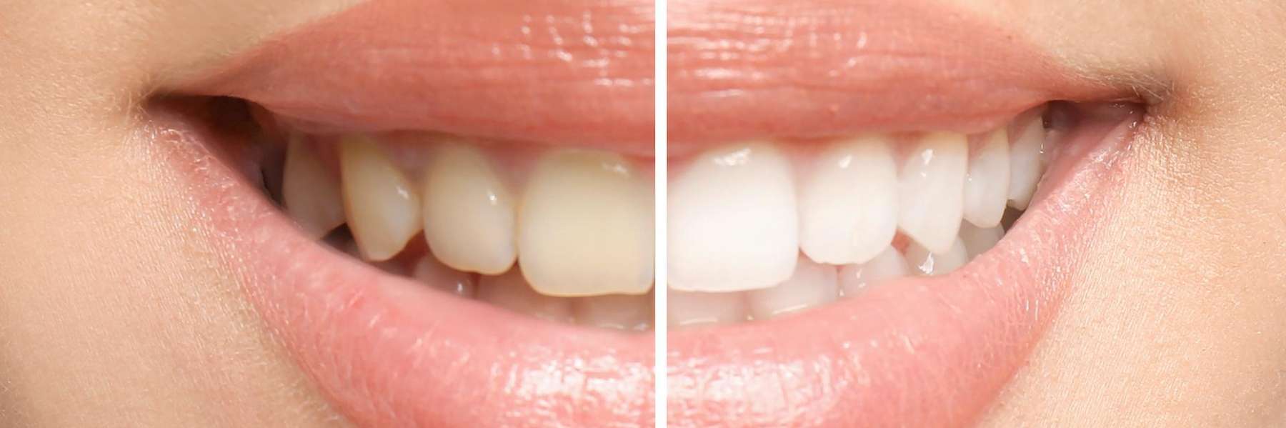 A before and after results of Cosmetic Dentistry procedure in Edmond, OK