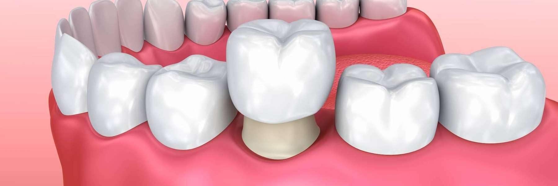 An Illustration of a Dental implant at Edmond dentist, Edmond OK