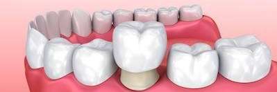 An illustration of dental crowns at Edmond Dental Center