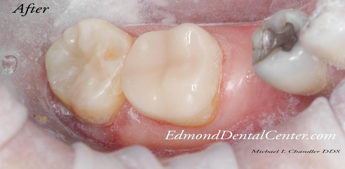 Close up of cavity restoration with tooth colored fillings in 73013
