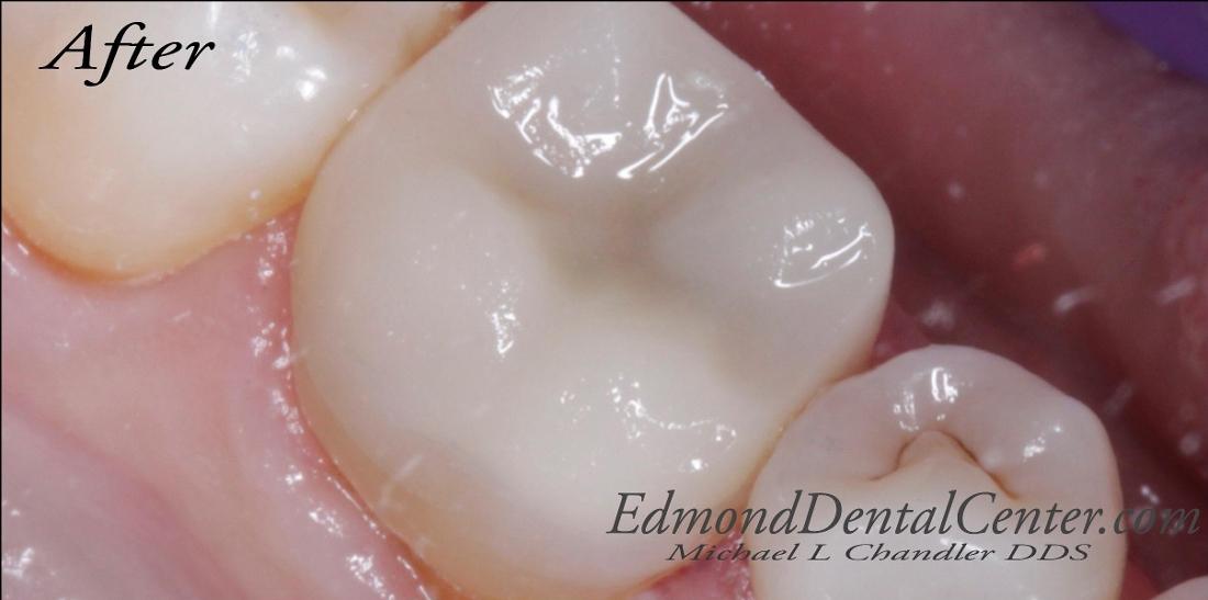 Results from tooth-colored filling procedure in Edmond OK