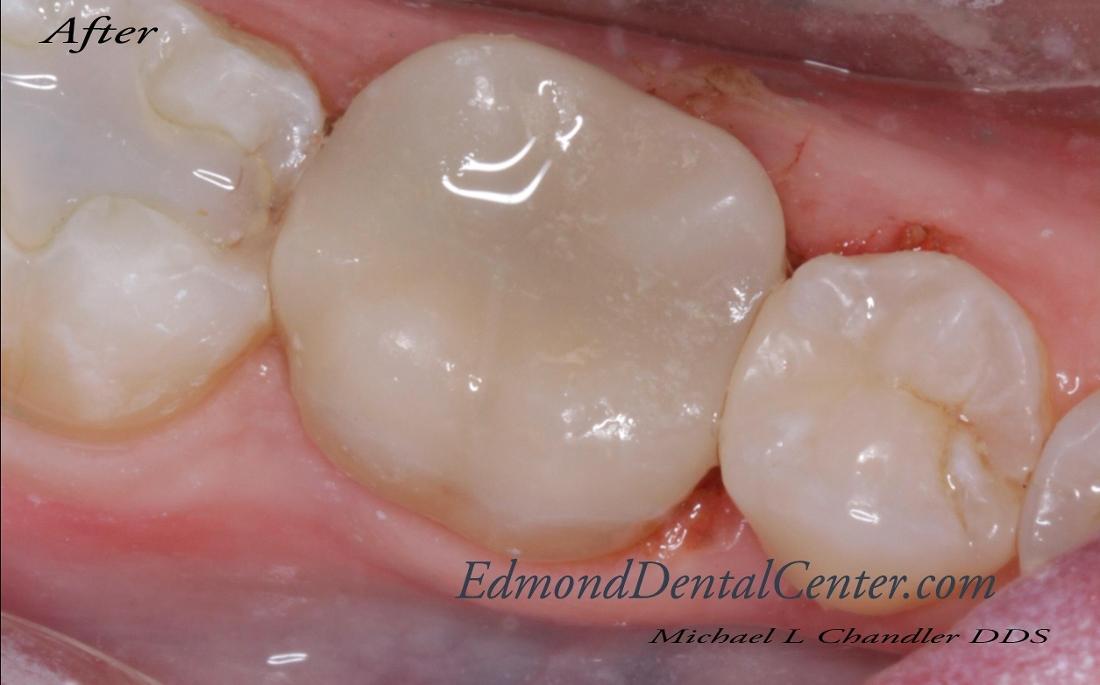 Results from tooth-colored filling procedure at Edmond Dental Center