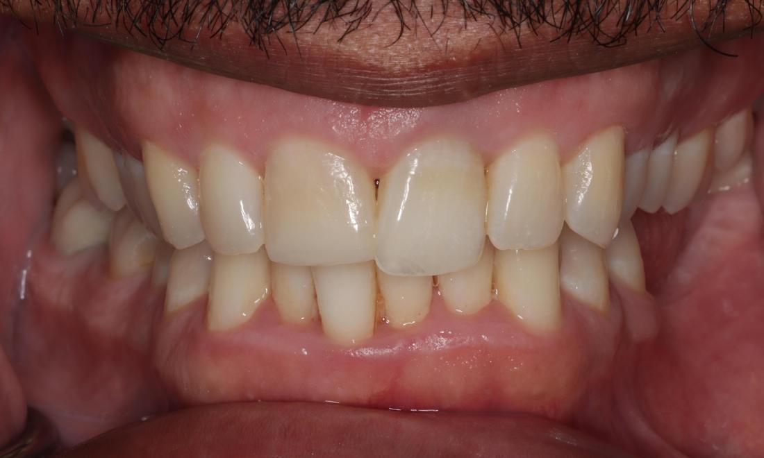 Results after cosmetic dentistry in Edmond, OK