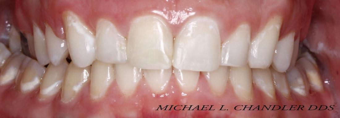 Results from teeth whitening & dental bonding in Edmond OK