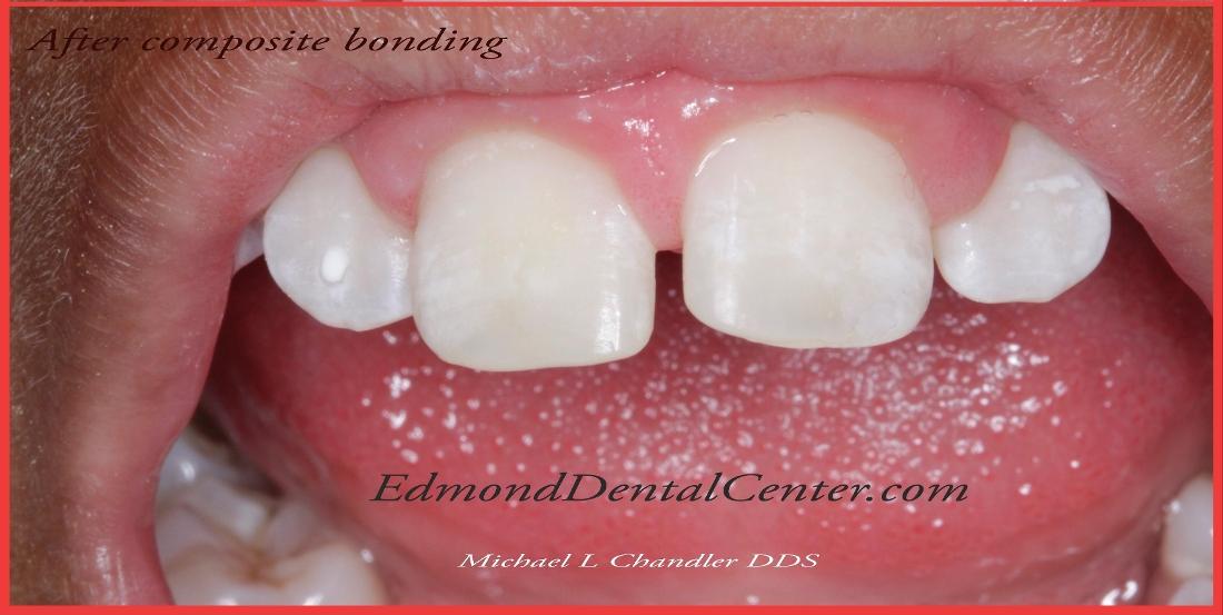 Results from procedure done by cosmetic dentist in Edmond OK