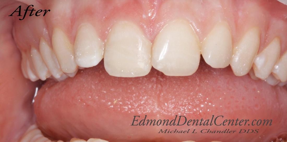 Close up of chipped tooth restoration with dental bonding in Edmond OK