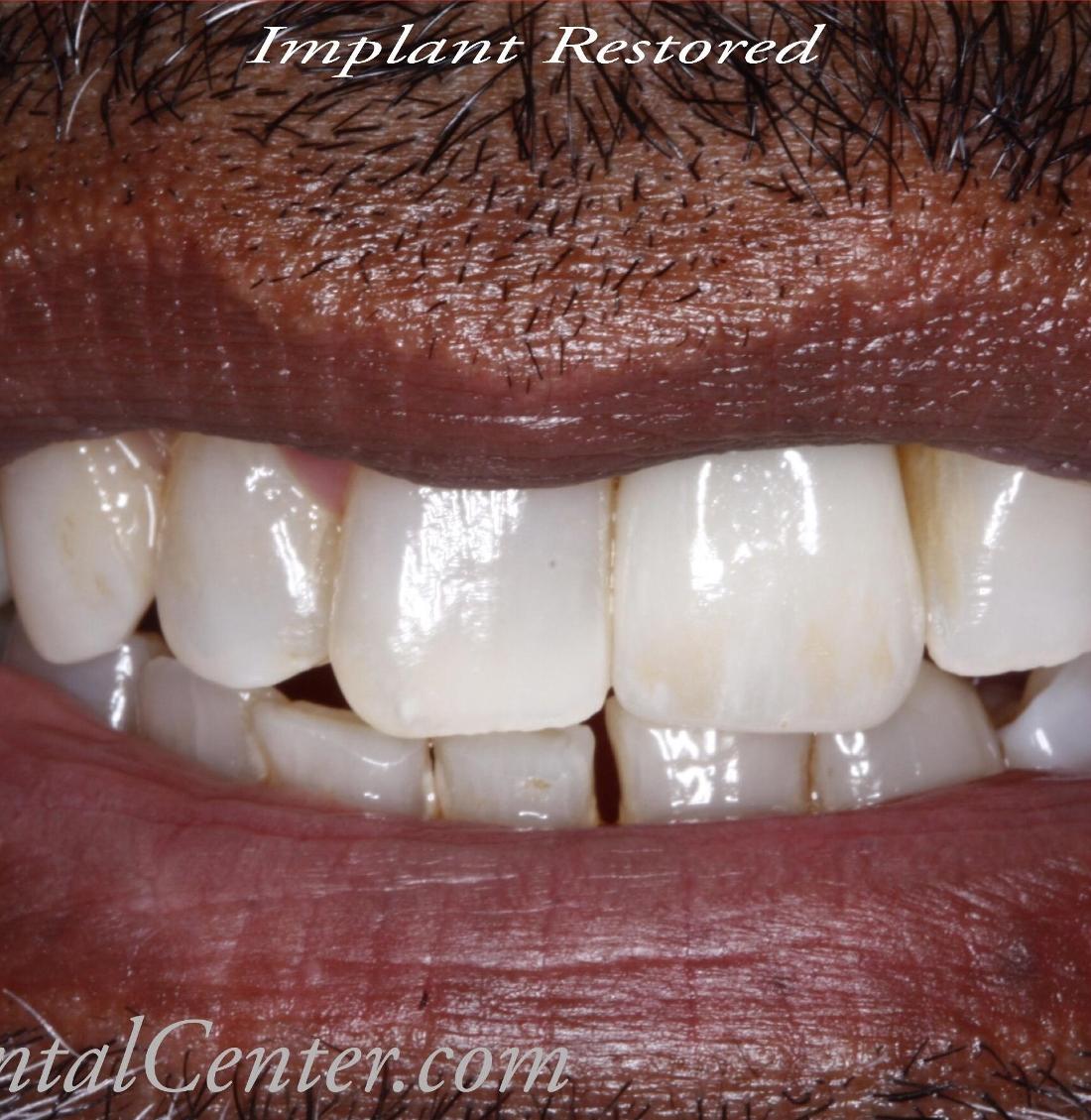 Close up of results after dental implant procedure in Edmond, OK