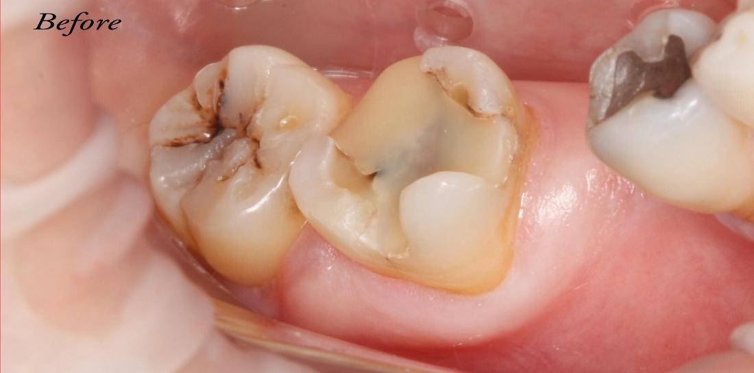 Patient with tooth decay and cavities at dentist office in Edmond OK
