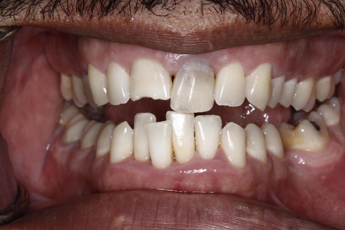 Close up of patients smile before cosmetic dentistry in Edmond, OK