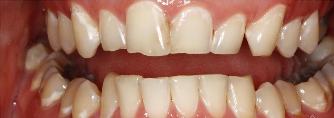 Before image of discolored teeth at Edmond Dental Center