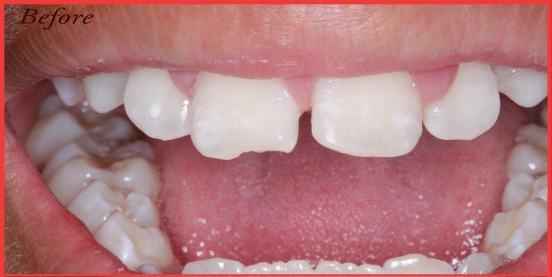 Close up of dental patient with chipped tooth at Edmond dentist office