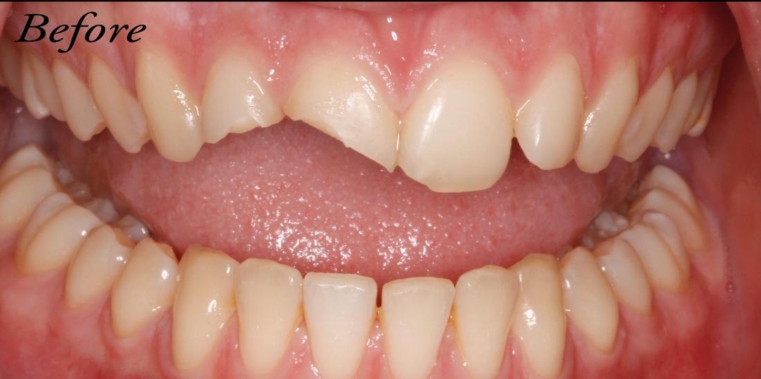 Patient with chipped teeth from dental emergency near 73013