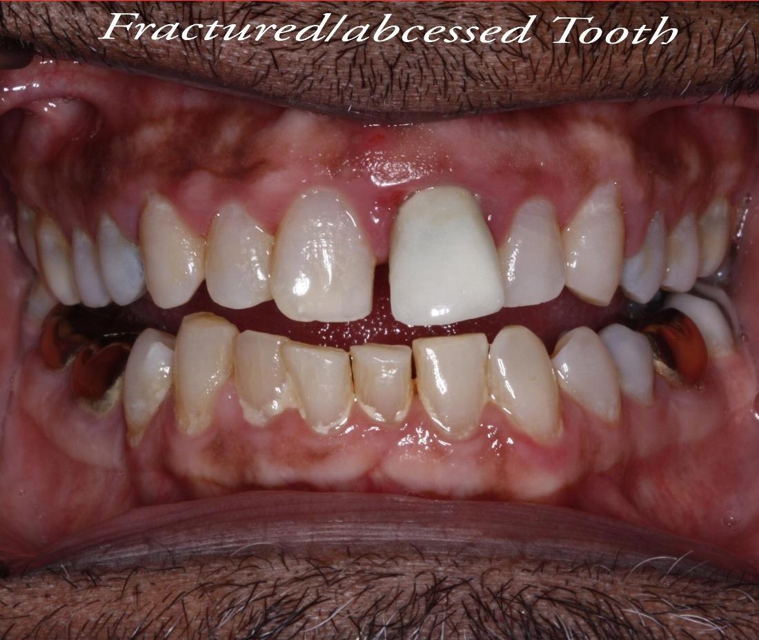 Patients teeth before dental implants in Edmond, OK