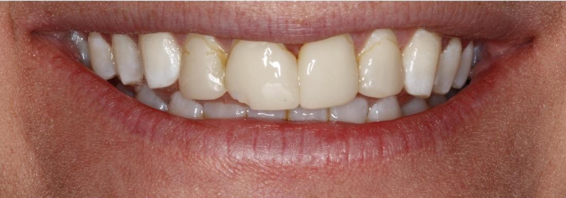 Close up of patients teeth before veneers in Edmond, OK