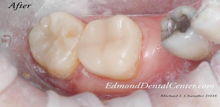 Close up of cavity restoration with tooth colored fillings in 73013