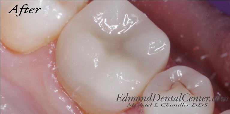 Results from tooth-colored filling procedure in Edmond OK