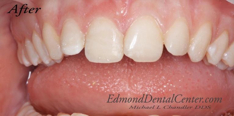 Dental-Bonding-After-Image