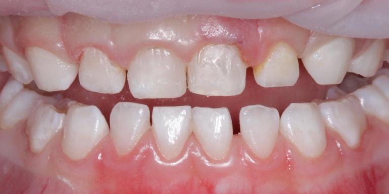 Pediatric-Dentistry-After-Image