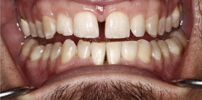 Results after periodontal treatment in Edmond, OK