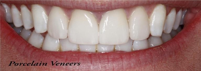 Porcelain-Veneers-After-Image