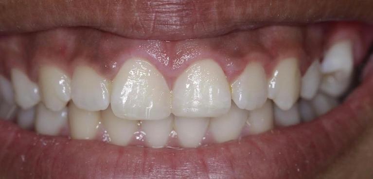 Results from dental bonding procedure in Edmond OK