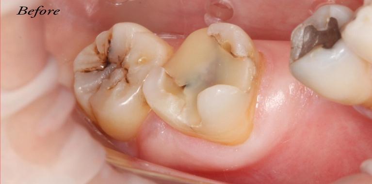 Patient with tooth decay and cavities at dentist office in Edmond OK