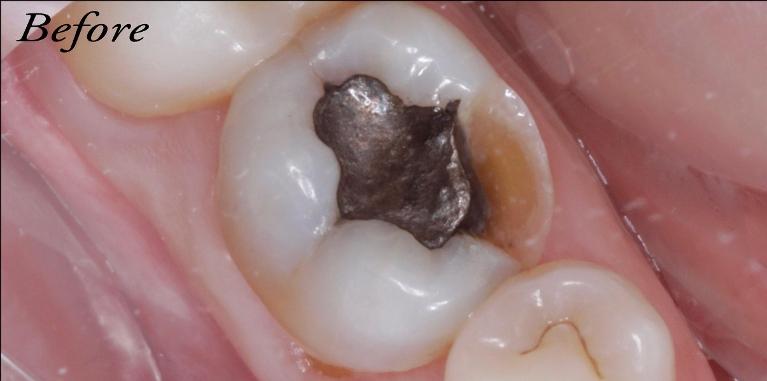 Close up of tooth with metal dental filling at Edmond Dental Center
