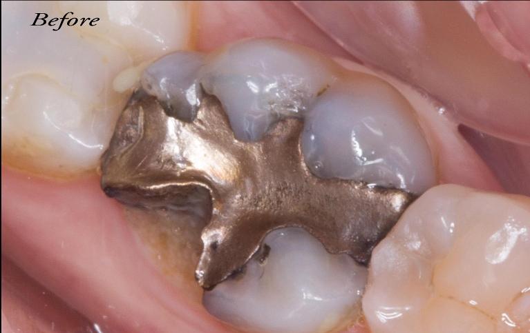 Close up of out-dated silver metal dental filling in 73013
