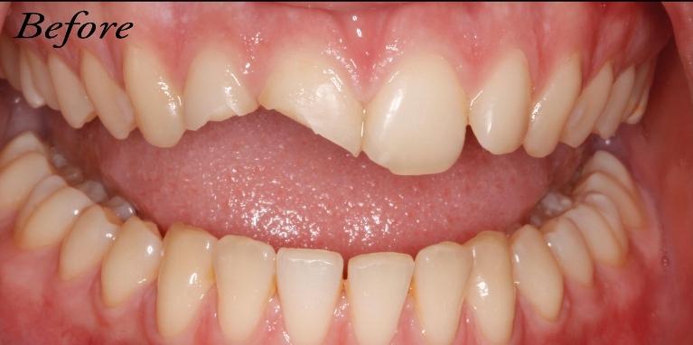 Dental-Bonding-Before-Image