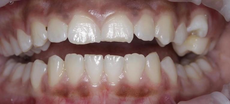 Close up of dental patient in need of dental bonding at Edmond Dental Center