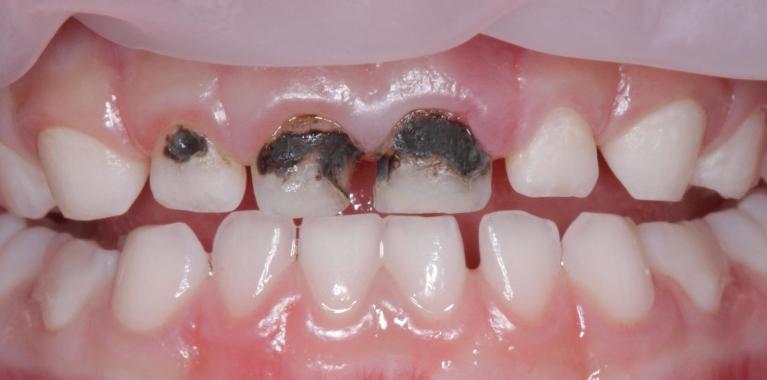 Pediatric-Dentistry-Before-Image