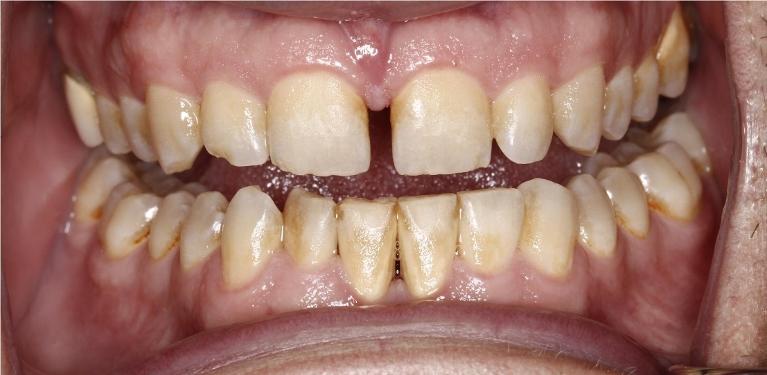 Close up of smile before deep dental cleaning in Edmond, OK